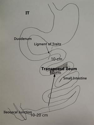 Roles of Gastric Emptying and Gastrointestinal Transit Following Ileal Interposition in Alleviating Diabetes in Goto-Kakizaki Rats